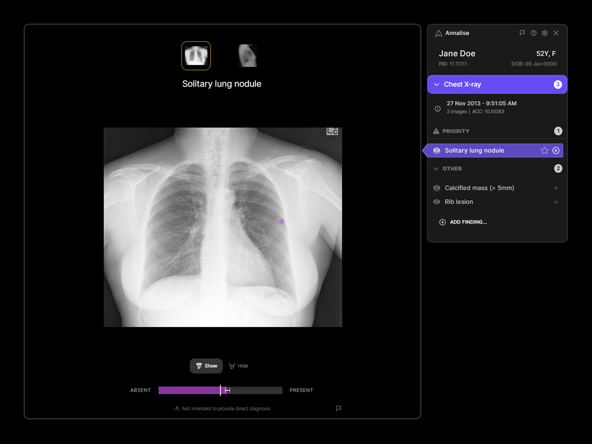 Yorkshire Imaging Collaborative leading the national roll out of new AI solution to support lung cancer diagnoses